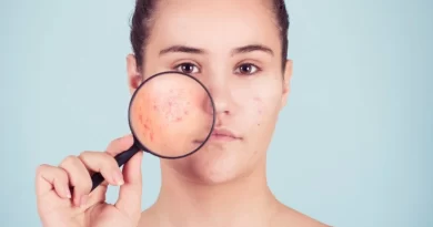 10-trucchi-anti-acne
